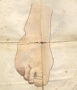 Medical drawing of right foot having been operated